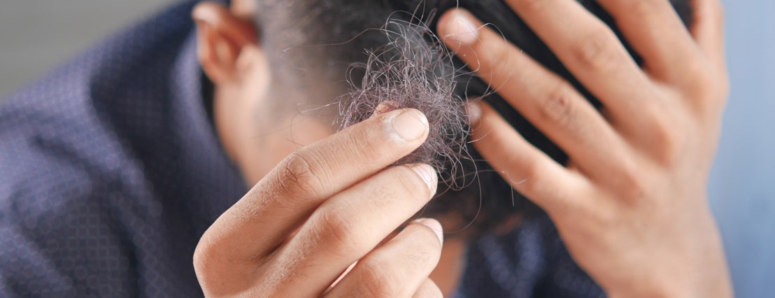 A man holding his head in his hand while holding the hair he is loosing in the other hand